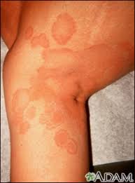 Ringworm Information Mount Sinai New York While there are multiple forms of ringworm, the most common affect the skin on the body (tinea corporis). ringworm information mount sinai