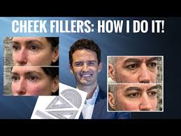 Injectors Guide: Cheek Fillers & Landmarks