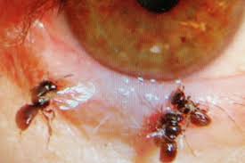 Probably crossing $4000 usd mark. Eye Ll Bee Damned Woman Finds Insects In Eye Arab News