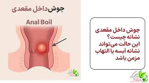 چه پمادی برای جوش مقعدی خوبه؟