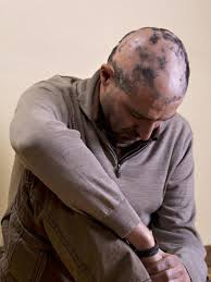 If you're a gentleman who has been noticing a receding hairline or is worried about balding, the first step is to schedule a visit (or phone consultation, for the time being) with a doctor or dermatologist and make sure your hair loss isn't a sign of a more serious health issue. Chemo Induced Alopecia Total Hair Loss Solutions