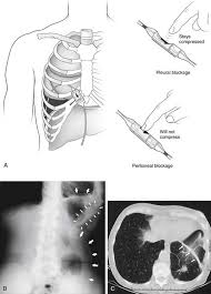 The pleura are thin membranes that line the lungs and the inside of the chest cavity and act to lubricate and facilitate breathing. Malignant Pleural And Pericardial Effusions Thoracic Key