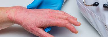 Prevalence of asthma in patients with atopic dermatitis: Dupilumab Einsatz Bei Atopischer Dermatitis Sollte Dauerhaft Sein Medical Tribune