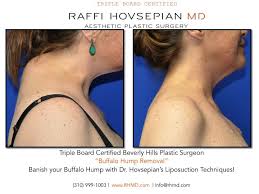 Pin On Dr Raffi Hovsepian M D Shrink Wrap Liposuction
