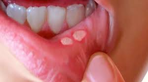 Salah satu jenis sariawan yang paling umum adalah canker sore. Mengobati Sariawan Di Lidah Rsud Dr Soeroto Kabupaten Ngawi