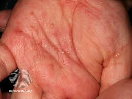 Image result for scabies human children