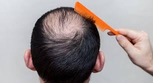 When you have diabetes, it can affect the hair growth cycle, slowing down hair growth as it grows back. In Some Men Hair Loss Begins At The Crown Of The Head Know Why Thehealthsite Com