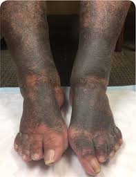 Image result for Pigment stains on the shin
