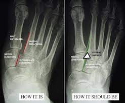 A lisfranc injury is an injury to the midfoot that often affects athletes in sports that involve sprinting and quickly changing directions, like football and soccer. Lisfranc Injuries A Matter Of Ligament Disruption The Journal Of Foot And Ankle Surgery