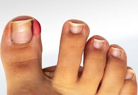 Image result for Beau lines feet