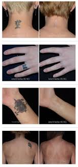 We estimate three to five sessions to fade for a cover up piece and ten to twelve sessions for full removal based on tattoo colors and sizing. Tattoo Excision Ask A Surgeon