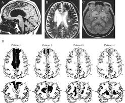 2.2 cerebral hemispheres (carotid/anterior circulation) stroke in this vascular distribution often results in contralateral paralysis or weakness (hemiparesis/hemiplegia), sensory loss and visual field loss (homonymous hemianopsia) (adams, 1997). Clinical Symptoms Of Bilateral Anterior Cerebral Artery Territory Infarction Sciencedirect