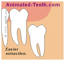 Estimating Wisdom Tooth Extraction Difficulty Erupted Impacted Teeth