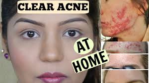 These diy overnight remedies can reduce its appearance and decrease the size of the bump on your face in hours or with repeated usage over days. How To Cure Acne Fast Overnight Skin Lightening Face Mask Superprincessjo Youtube