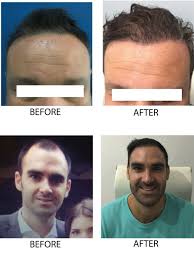 Ideally, leave your hair to rest for at least 3 weeks before starting the treatment again, so you avoid your hair becoming too accustomed to it. Hair In 1 Day Guadalajara Mexico