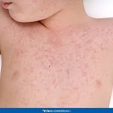 Gli eritemi sono un sintomo di molti e diversi problemi medici, come allergie, intossicazioni alimentari o infezioni virali e batteriche. Quinta Malattia Nei Bambini E Negli Adulti Durata Sintomi E Prevenzione
