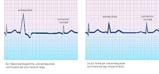 Image result for Extrasystole