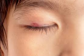 When i arrived, the power was out in the area, but they greeted me with the same calm and outstanding service. Entropion Symptoms Causes And Treatment