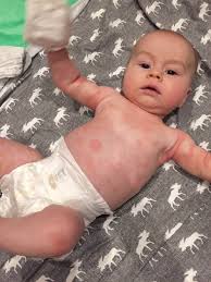 Allergies in infants and children are common; Symptoms Of Allergic Reactions In Babies Solid Starts