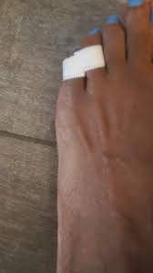 It is supplied by its own tendons from the flexor digiti minimi brevis also contained within the pinky toe are the lateral plantar and dorsal digital arteries, the tendons of the flexor digitorum longus and brevis muscles, the. Sprained Pinky Toe Fashion Thisisyourbestyear