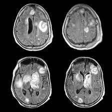 Metastatic breast cancer, also referred to as metastases, advanced breast cancer, secondary tumors, secondaries or stage iv breast cancer, is a stage of breast cancer where the breast cancer cells have spread to distant sites beyond the axillary lymph. Metastatic Disease Late