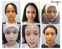Total Transformation At Id Hospital Korea Forehead Reduction Surgery Forehead Reduction Plastic Surgery
