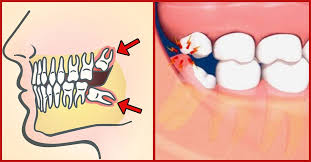 Pin On Tooth Ache
