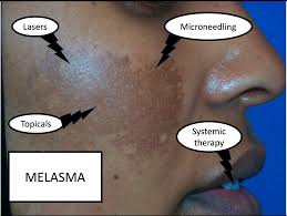 Image result for Melasma