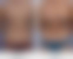 Breast Lift In Lethbridge, Alberta | Lethbridge Plastic Surgery
