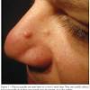 Tumor feels hard, is well defined, and is asymptomatic. 3