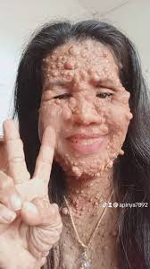 denied surgery for neurofibromatosis