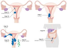 This is the lining of a woman's uterus. Endometrial Cancer Risk Factors Staging Surgery Teachmeobgyn