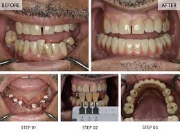 Image result for dental implant