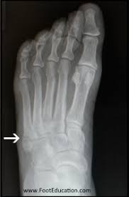Use the video or information below to you may walk on the foot as comfort allows but you may find it easier to walk on your heel in the early stages. 5th Metatarsal Avulsion Fracture Footeducation