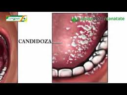 In cele mai multe cazuri, barbatii sunt asimptomatici, asadar nu vor sti ca au contractat o infectie genitala. Candidoza Bucala Orofaringiana Youtube