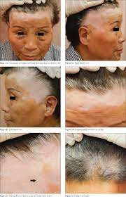 It can affect the skin on any part of the body melanin is responsible for the colour of our skin, eyes and hair. Indian Journal Of Dermatology Venereology And Leprology Frontal Fibrosing Alopecia Developing On Vitiligo