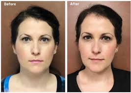 How to get botox covered by insurance. Tmj Tmd Treatment Charleston Sc Headaches Treatment Tatum Dentistry