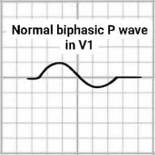 Image result for P Wave