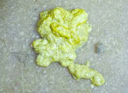 Image result for yellow stool human poop