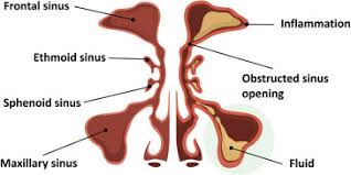 Image result for Sinusitis Prediction Rule