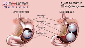 Gastric Balloon Placement In 2020 Gastric Balloons Bariatric Surgery Intragastric Balloon