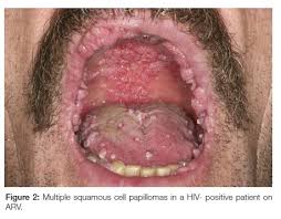 Image result for papillomavirus tongue)