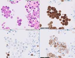 Check spelling or type a new query. Pathology Outlines Epithelial Membrane Antigen Ema