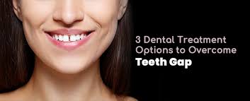 Here's how to fix them: 3 Dental Treatment Options To Overcome Teeth Gap Cosmetic Dentist In Pune