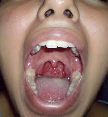 Image result for Pharyngitis