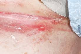 Image result for Candidiasis under breasts