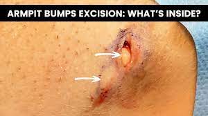 In case the pain is mild, they do disappear on their own. Armpit Bumps Excision Cyst Or Lipoma Youtube