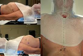 While some women may prefer a reversible method such as this, these marks have to be kept dry until the end of therapy. Quality Improvement Investigation For Head And Neck Stabilization In Radiotherapy Using Setup Tattoos Journal Of Medical Imaging And Radiation Sciences
