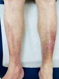 Image result for Stasis Dermatitis