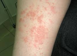 Der hautausschlag wird zusammen mit anderen allergischen symptomen auftreten. Allergieanfall Erste Hilfe Bei Allergien Dringende Massnahmen Bei Allergien